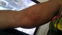 My Scar