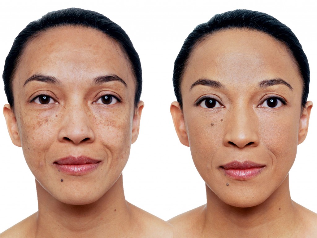 A-before-and-after-picture-of-a-woman-using-Vichy-Dermablend